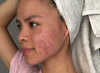 The Acne Breakdown: Root Causes And Why You Have It